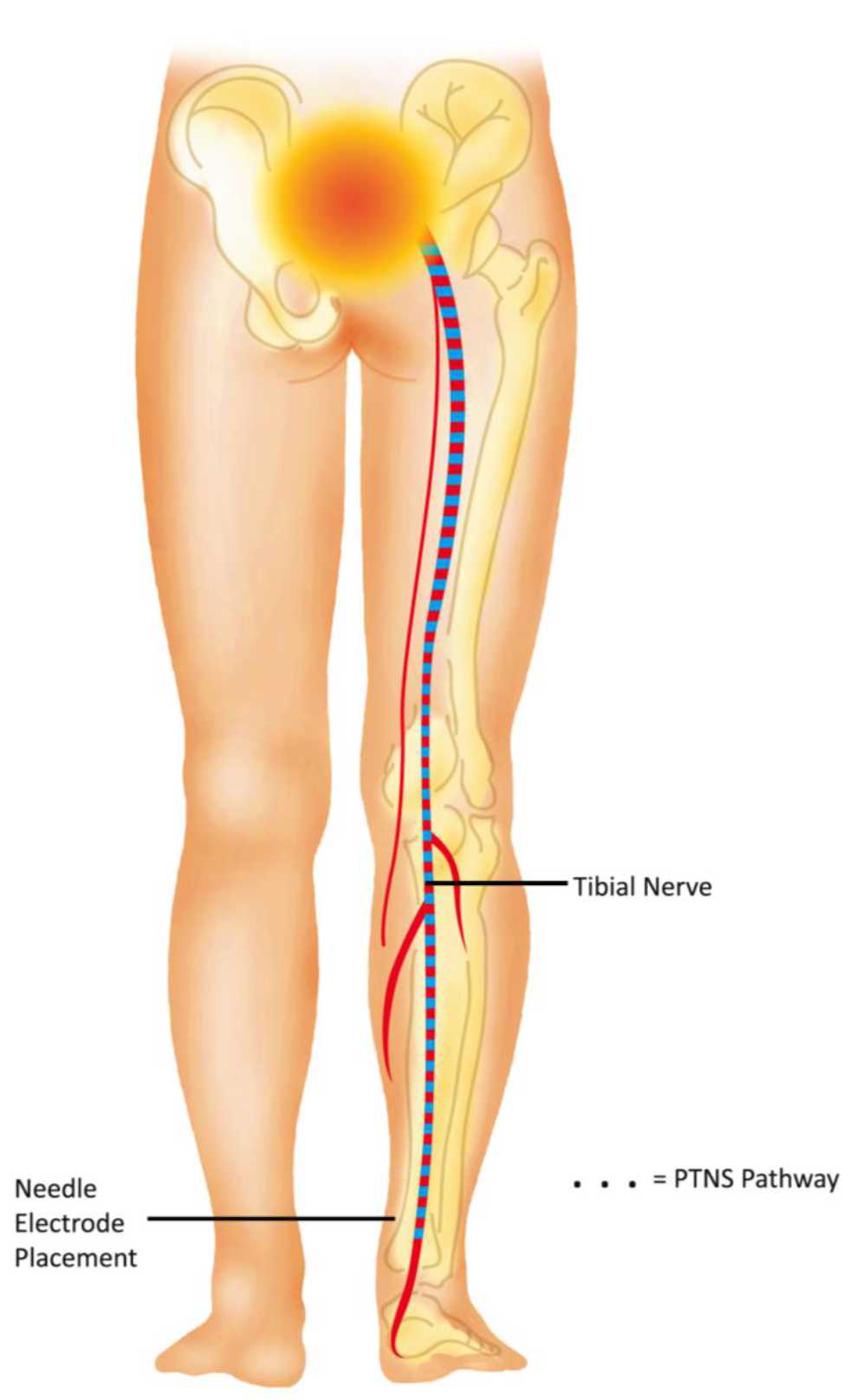 Tibial nerve stimulation using rechargeable TENS Unit : r/OveractiveBladder