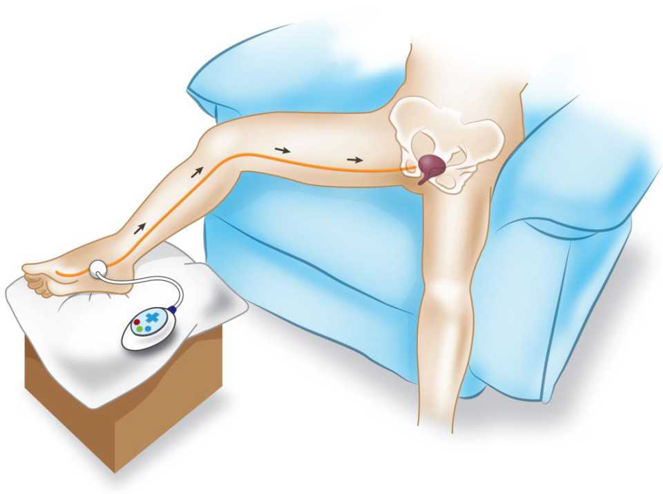 Percutaneous Tibial Nerve Stimulation (PTNS) and Transcutaneous Electrical  Nerve Stimulation (TENS)